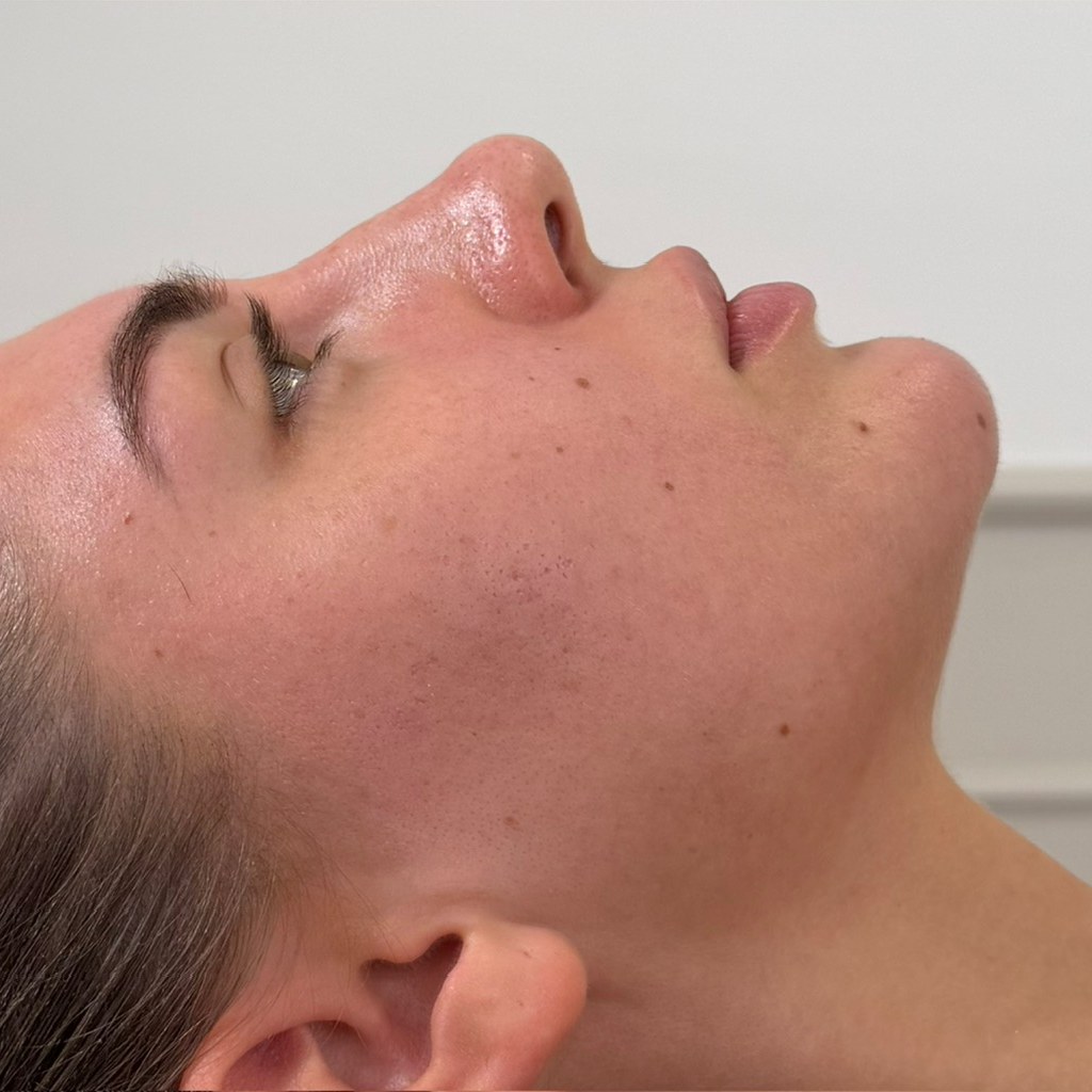 Skin and profile after