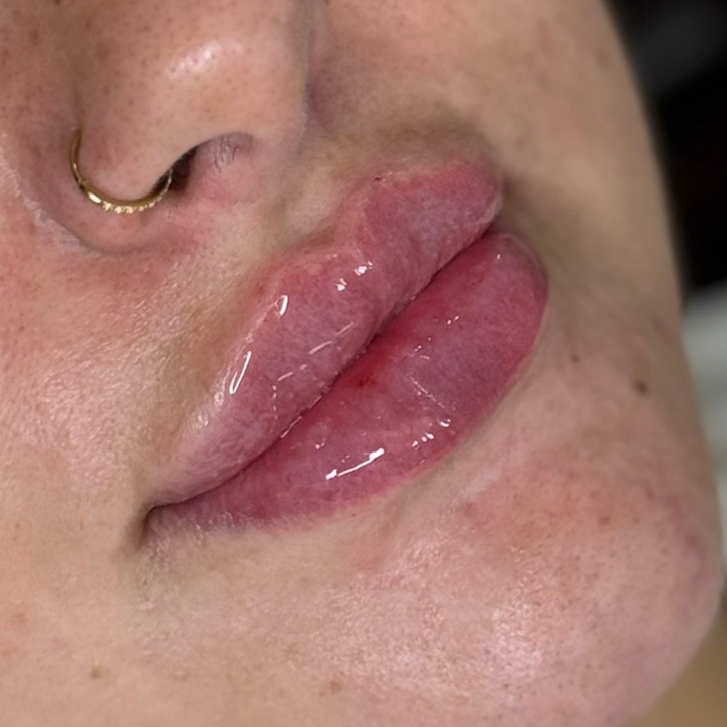 Lip treatment 1 after