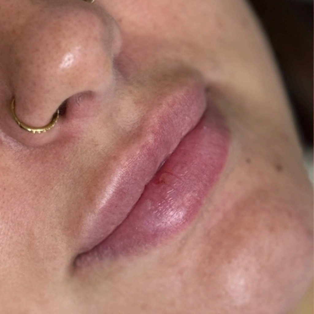 Lip treatment 1 before