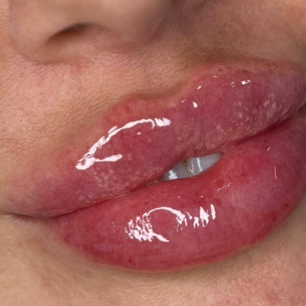 Lip treatment 2 after