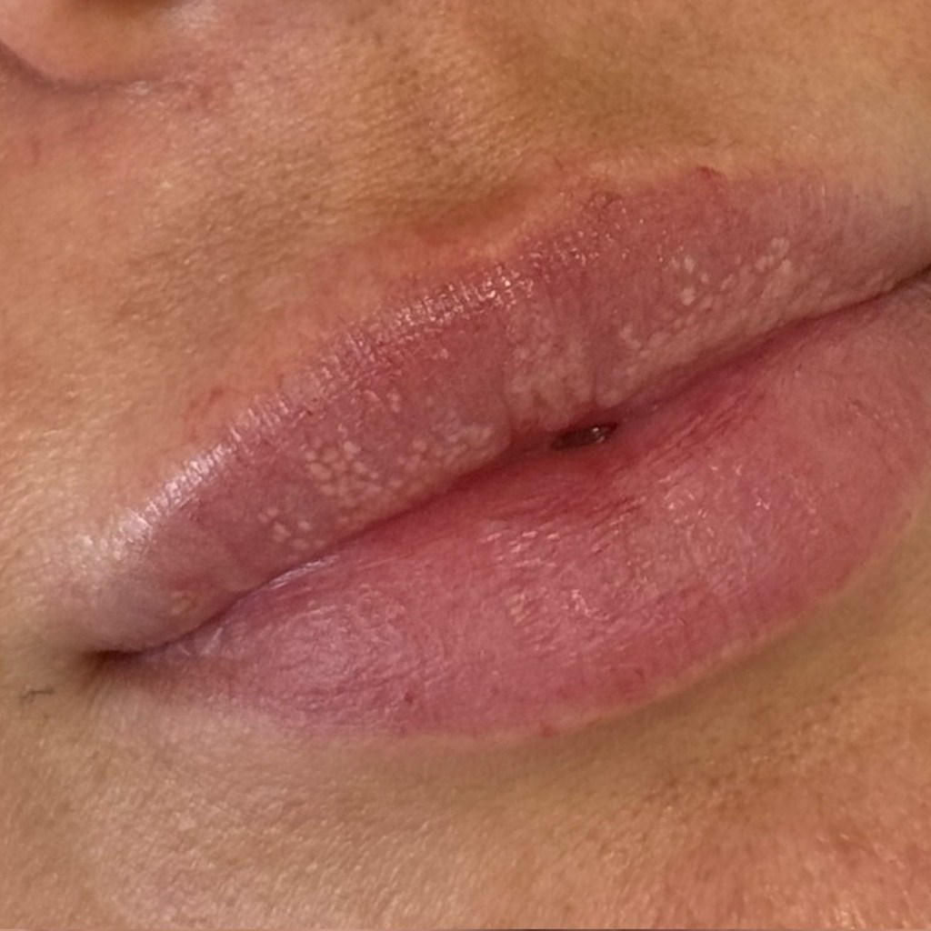 Lip treatment 2 before